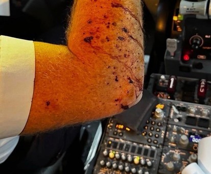 Der verletzte Arm des Piloten: Was ließ die Scheibe zersplittern?