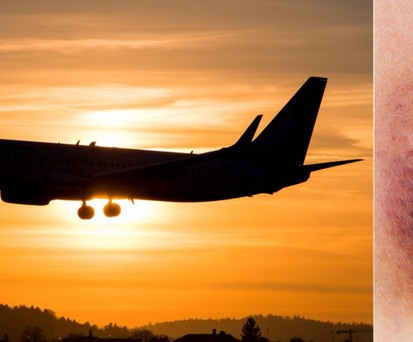 Flugzeug und Bluterguss: Ein wachsames Auge ist gefragt.
