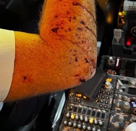 Der verletzte Arm des Piloten: Was ließ die Scheibe zersplittern?